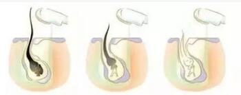 Permanent SHR Hair Removal Machine 3500W IPL Peak Power Skin Rejuvenation