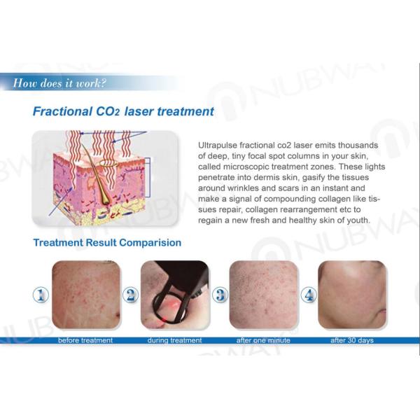 Fractional CO2 Laser Equipment Fractional CO2 Laser Skin Resurfacing