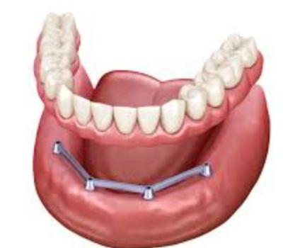 Screw Retained Translucency Implant Bar Denture Polished Surface Implant Bar