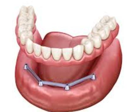 Screw Retained Translucency Implant Bar Denture Polished Surface Implant Bar