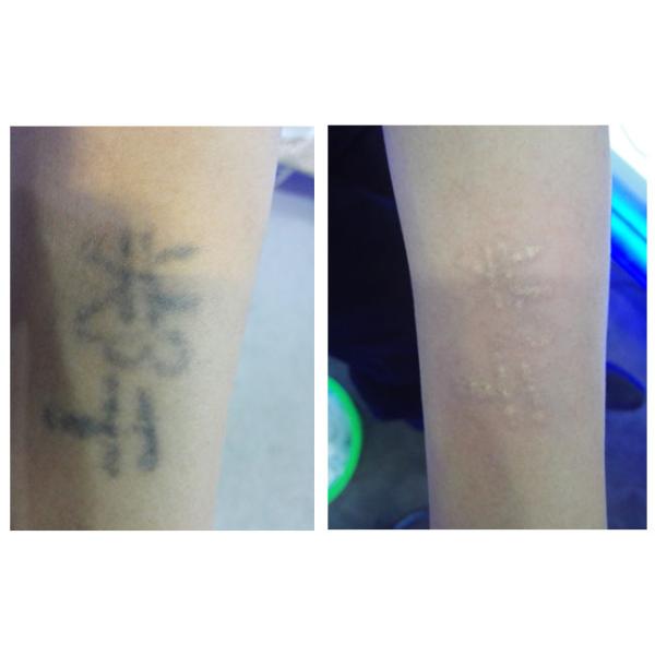 1-20Hz Medical Tattoo Removal , Q Switched Picosecond Laser Honeycomb Skin Rejuvenation