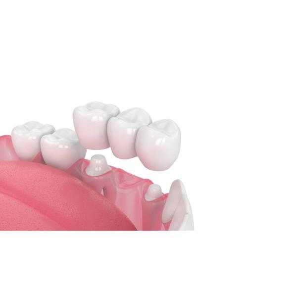 磁器橋強い非刺激する快適で強い耐久性
