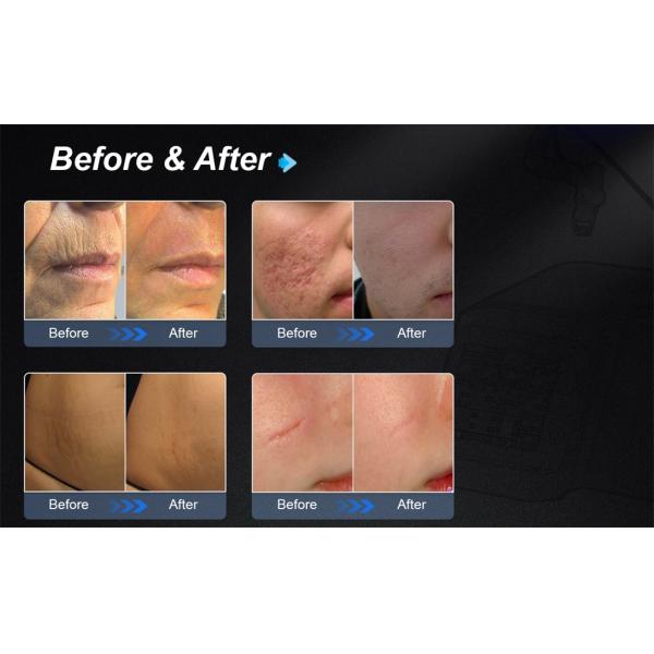 Машина лазера Laser/Co2 самого нового СО2 Protable частичная хирургическая медицинская