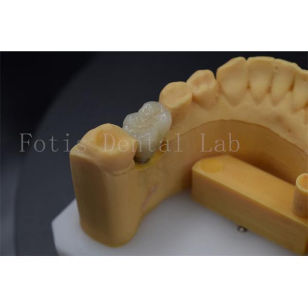 Coroas de implante dental confortáveis e duradouras para restauração de dentes