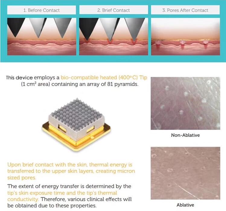 Термальное частичное удаление шрама машины RF Microneedle