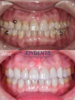 Porcelain Veneer Oral Restoration