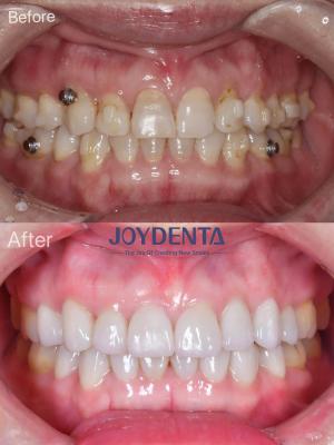 Porcelain Veneer Oral Restoration