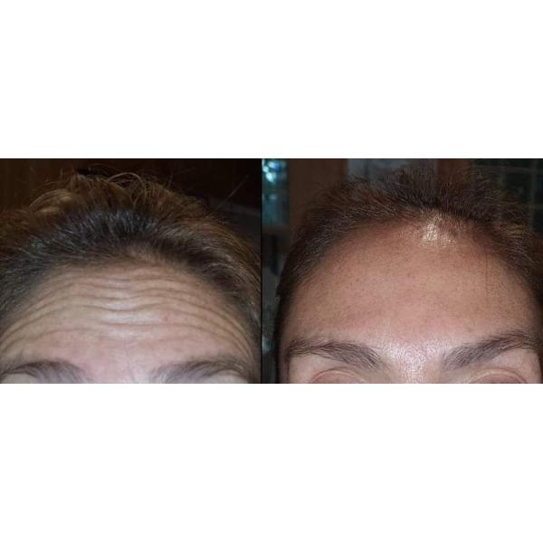 Анти- старея Ce Hyamely  100 Ui для морщинок