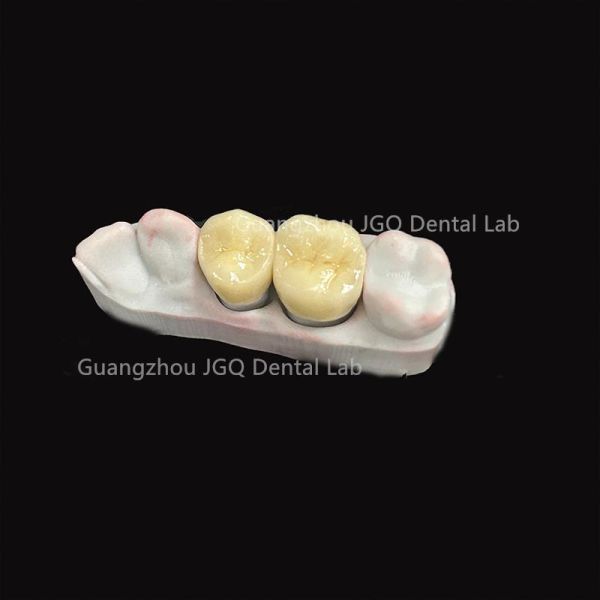 Custom China Dental Laboratory Zirconia Crown Bridge for Global Clinics