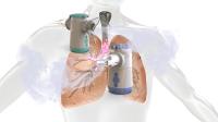 Appareil de décharge d'aérosol très efficace - Inhalateur nébuliseur avec alimentation en courant alternatif / continu