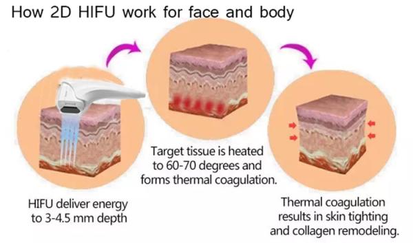 Corps 3D de bureau amincissant la peau de machine d'ultrason serrant le retrait de ride