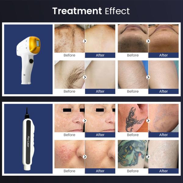 4 длины волны воздушного охлаждения Диод лазерная эпиляция + Nd Yag Пикосекундная эпиляция татуировки