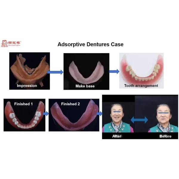 Customized Removable Dentures 3D Laser Printing CE Certified for Secure Fit