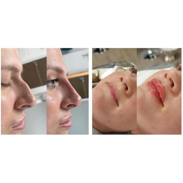 Cosméticos Cuidados da Pele Injecções Plumper de Lábios Juvederm Filler Injeção Para Nariz Chin Lip