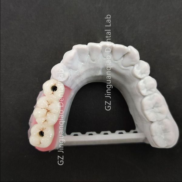 Dental Zirconia Custom Abutment Lab Precise Esthetical As Strong As Titanium