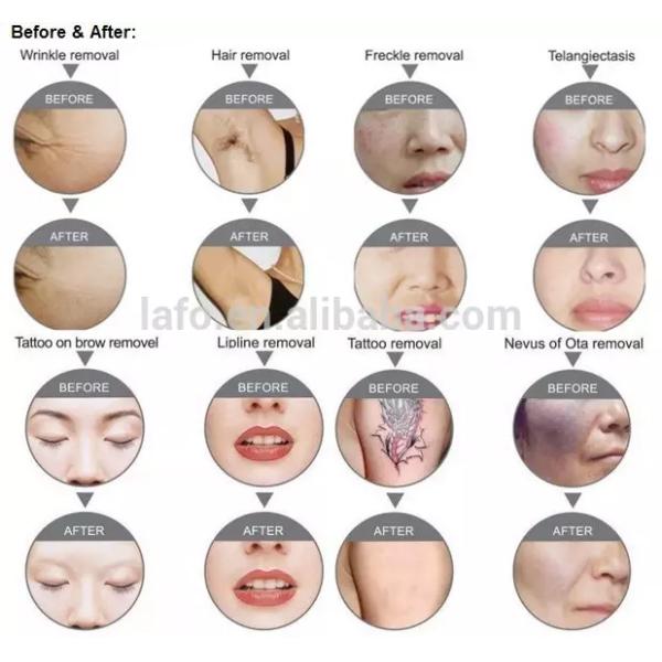 Portable hair removal machine /shr ipl/ipl shr hair removal machine