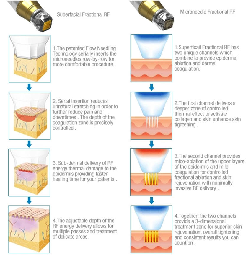 Степень Microneedling Frational RF удаления 45 меток Strectch