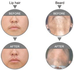 Efficiency Diode Medical Laser Equipment For Hair Removal / Acne Pigmentation Removal