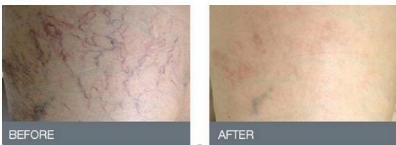 Beauty Clinic No Pain Shockwave Therapy Machine Non - Invasive 2 Years Warranty
