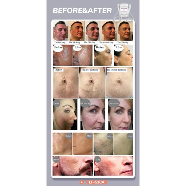 LF-518A Good Effective Thermal Fractional Scar Removal And Stretch Marks Removal Beauty Machine