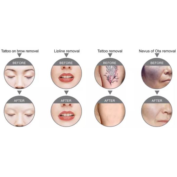 Жара машины лазера IPL OPT ELight RF YAG охлаждая для Multi машины обработок