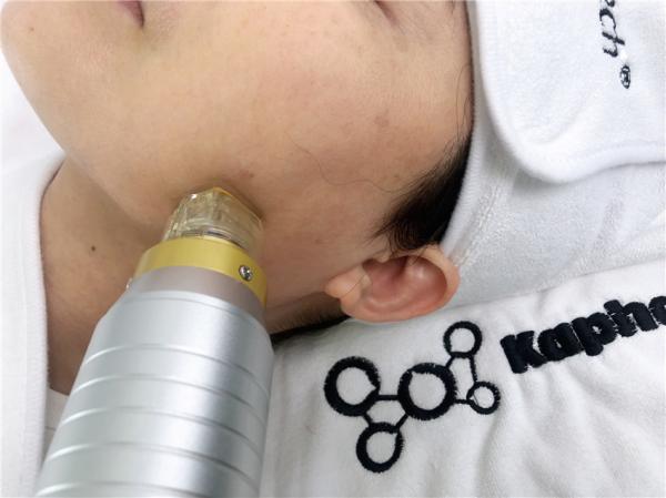Pele que aperta AC110V 180W Microneedling RF fracionário