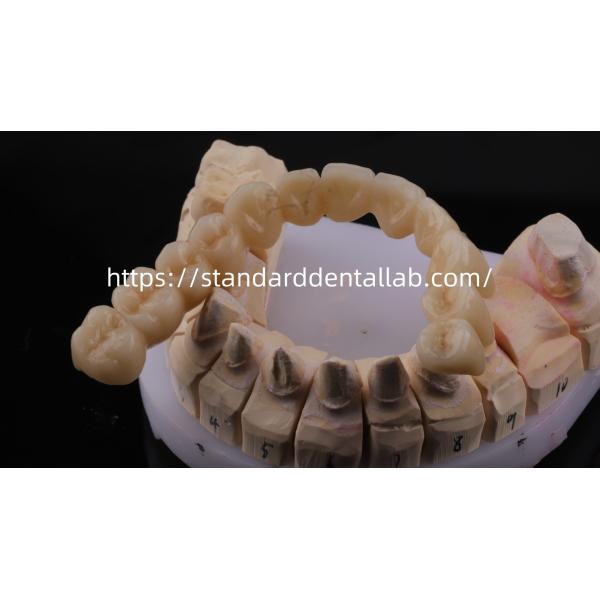Высокопрочный и естественный по внешнему виду слоистый фарфор для слоистой стоматологии Циркония корона Китай стоматологическая лаборатория