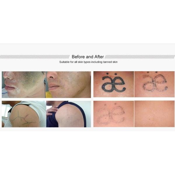 Q Switched Nd Yag Laser Tattoo Removal Machine Zeus Mode 1064nm / 532nm Wavelength