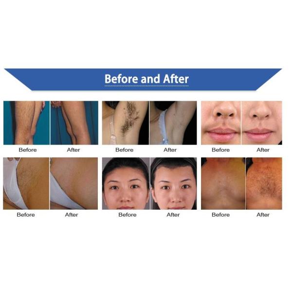 Painless Diode Laser Hair Removal Machine Full Body Permanent Hair Removal Devices