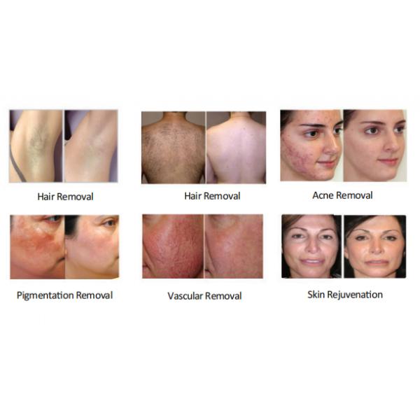 Permanent E-Light IPL Beauty Equipment Hair Removal With Spot Size 12*33mm² 15*50mm²