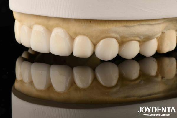 Dental Biomimetic Aesthetic Diagnostic  Wax-Up Of Veneers