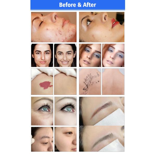 Q Switched Nd Yag Лазерная машина для удаления татуировок Удаление рубцов от прыщей Лазерная машина для удаления рубцов от прыщей Лазерная машина для удаления рубцов от прыщей