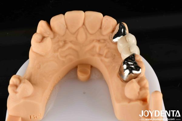 Metallic Dental Maryland Bonded Bridge Good Remediation For Oral Clinical Repair