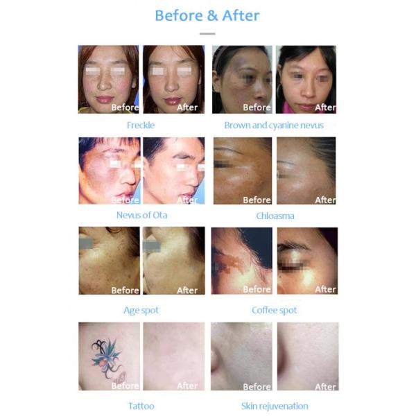 Машина 100-500mJ лазера пикосекунды удаления 1064nm татуировки