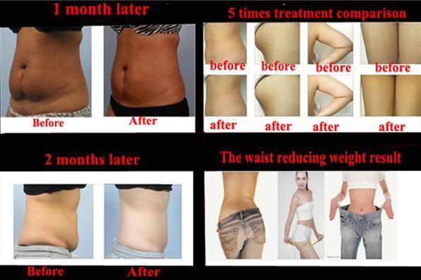 direct factory !!! high quality and competitive price Cryolipolysis Slimming Machine