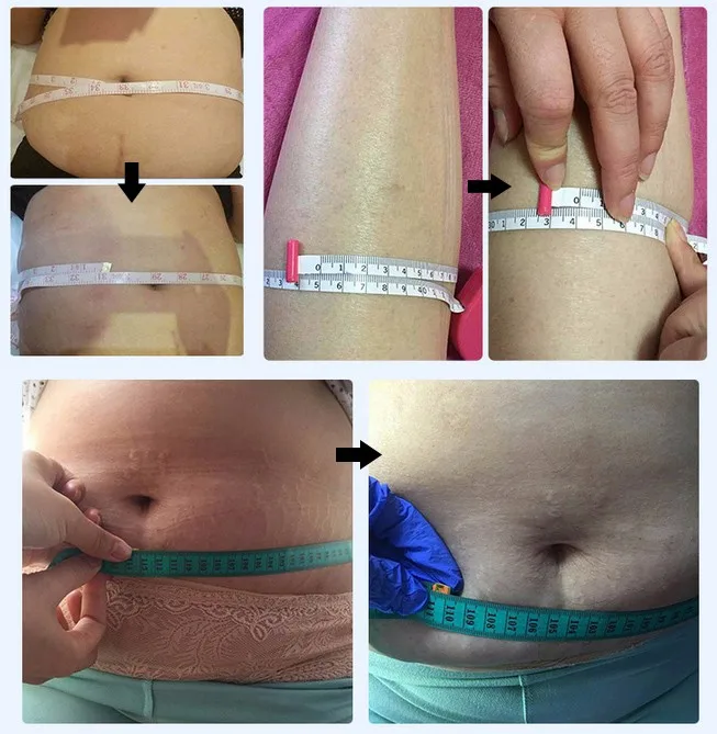laser liposuction fat reducing lipolaser slimming machine