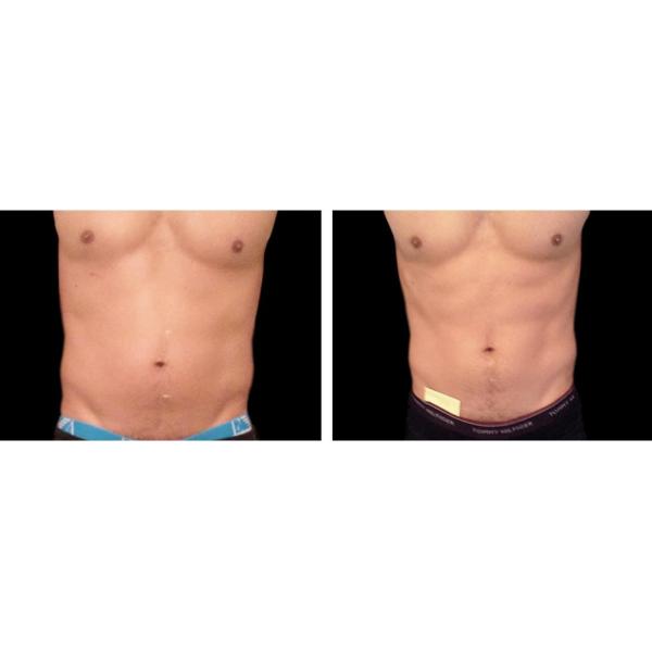 Ce Approved 7 Tesla Body Sculpting Machine 