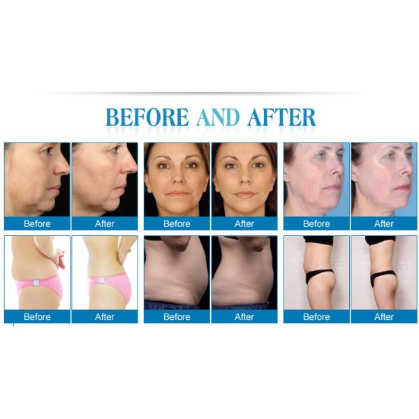 Face Lifting HIFU Beauty Machine High Intensity Vaginal Tightening Equipment