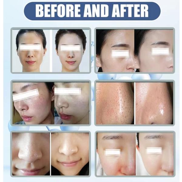 Mejor cuidado facial en el hogar Máquina de microdermoabrasión 2024 Equipo de belleza