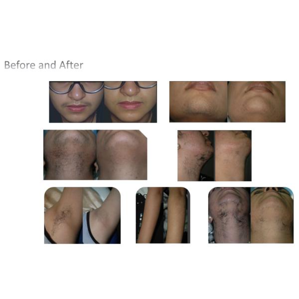 ISO HR SR IPL Skin Rejuvenation Machine SHR Hair Removal Device