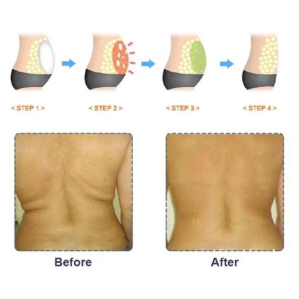 Впрыски Kybella 10Ml/Vial красного решения липолиза жирные растворяя