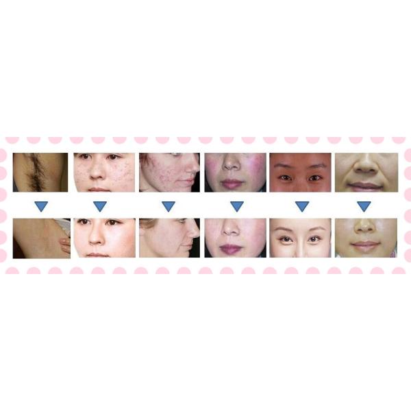 SR / HR Beauty Machine For OPT SHR Elight Hair Removal Treatment machine