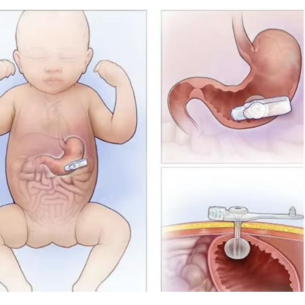 Sterilized Hospital Surgery Consumables Balloon G Tube 12FR-24FR