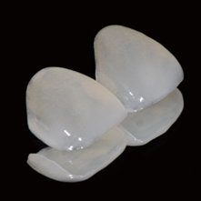 Emax Veneer Dental Veneer with Flexural Strength up to ~600MPa Seamlessly Blends with Natural Teeth and Mimics Natural Color