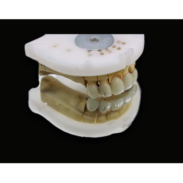Premium Quality Dental Product Porcelain-Fused-to-Metal (PFM) Crowns
