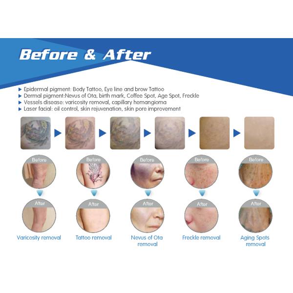 2019 Popular Nubway Q Switched Nd Yag long pulse laser tattoo laser removal machine