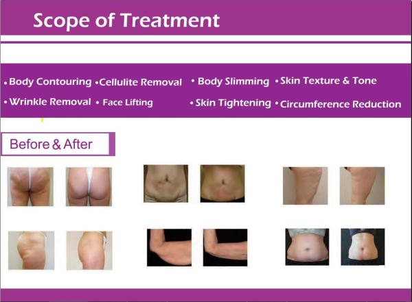 Whole body treatment beauty equipment vacuum roller rf skin tightening face slimming machine