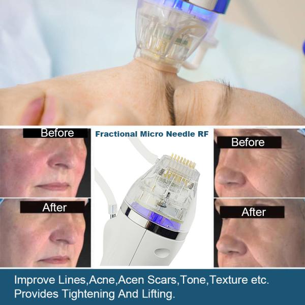 Golden Nano Fractional RF Microneedling Devices For Home Acne Removal