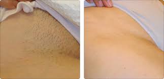 10 years factory best ipl machine price ipl epilator pulsed light professional