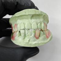 Résine thermoplastique de haute précision, résine de base de dentition partielle flexible
